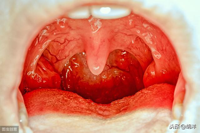 扁桃体虽小,竟然也会生癌,东方艳后确诊该病,一习惯是