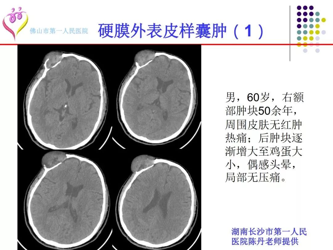 颅脑表皮样囊肿的影像学特征