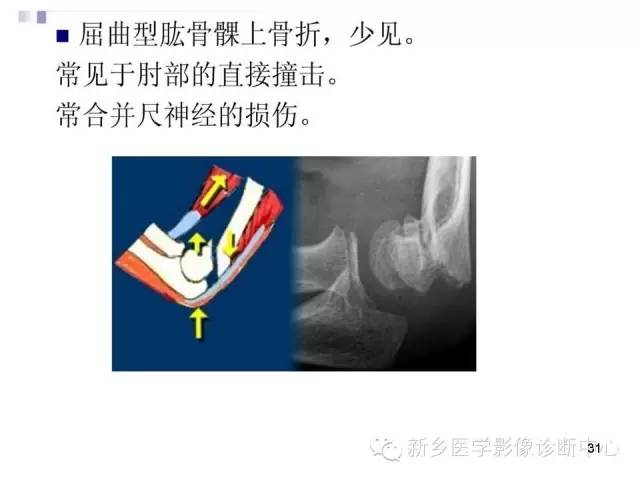 难点!儿童肘关节的骨折,仔细看看这个