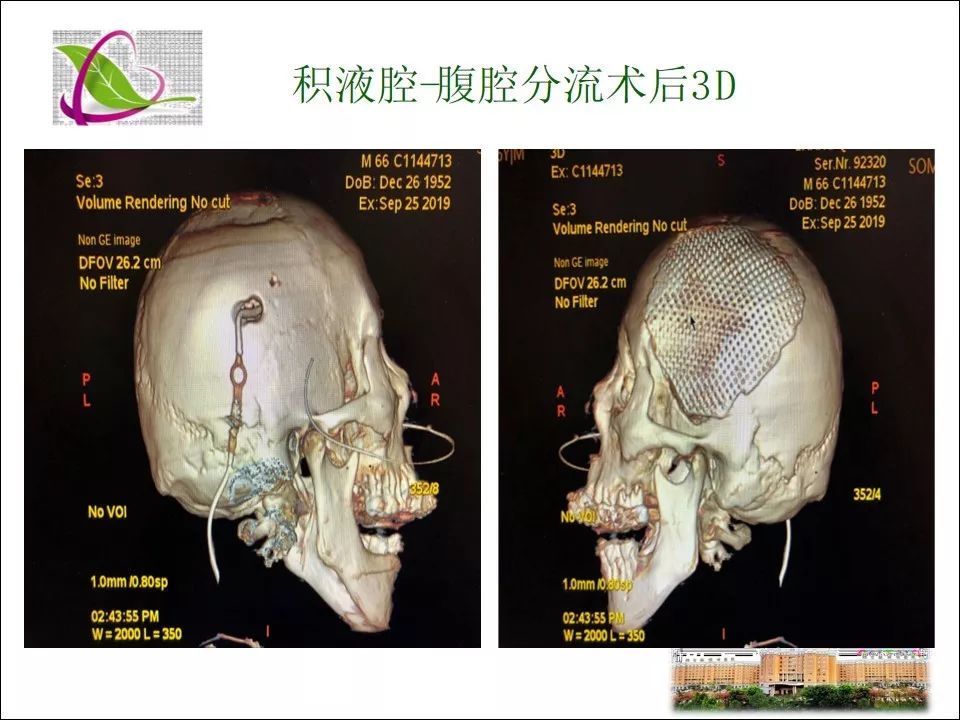 重型颅脑外伤去骨瓣减压术后并发对侧进展型难治性硬膜下积液处理及