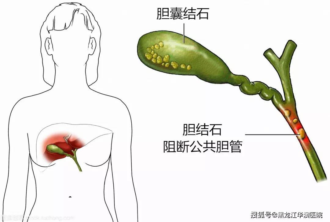 切除胆囊后可能会发生胆汁反流性胃炎;实际上, 绝大多数患者切除后都