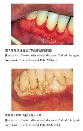 艾滋病与口腔还有这种关系?这些情况你一定要警惕