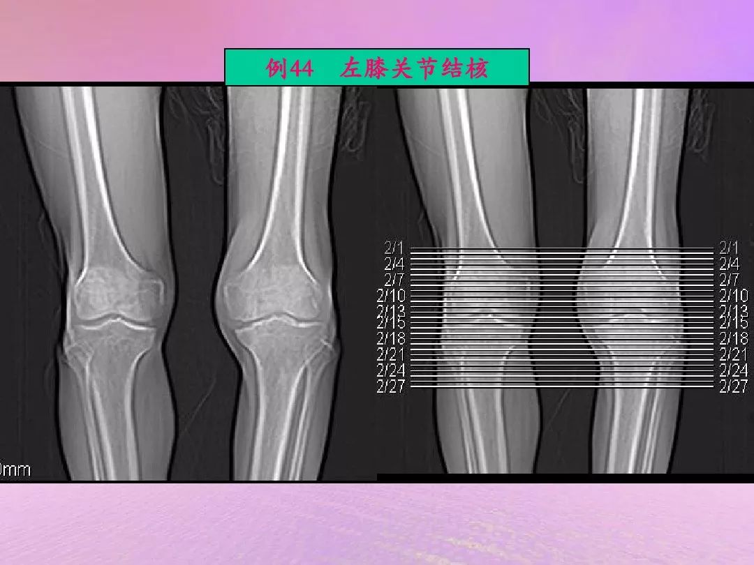 膝关节正常解剖及常见病变的影像表现