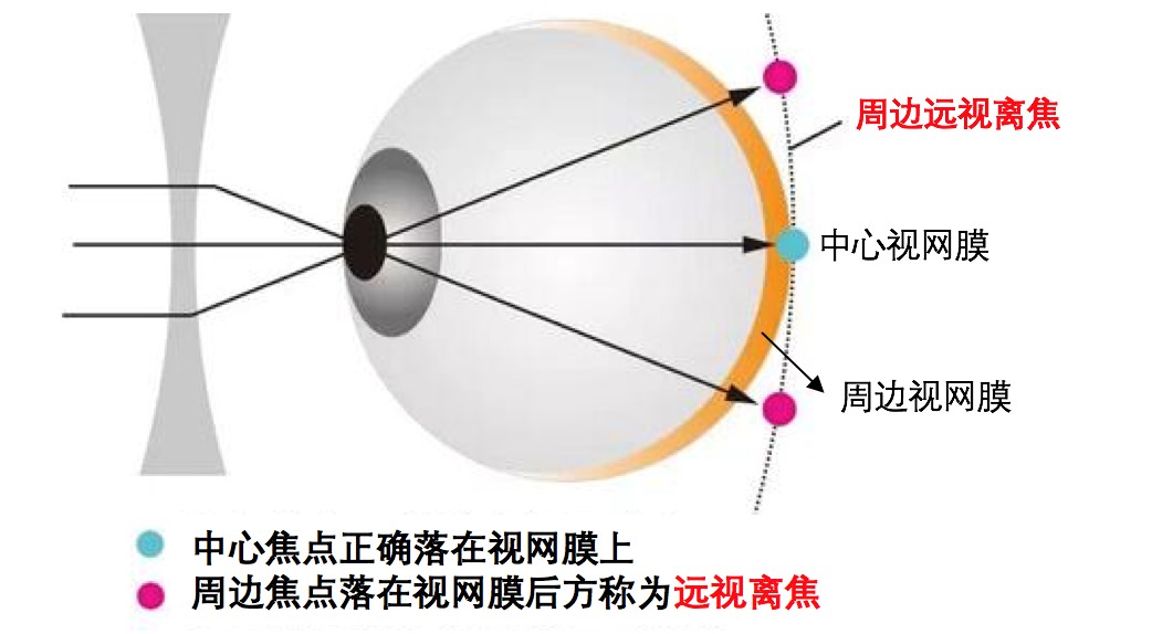 儿童近视控制之周边离焦