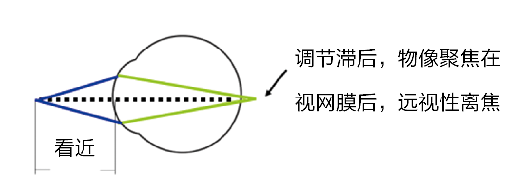 图3 内隐斜和(或)高ac/a的患者看近时调节滞后形成远视性离焦5 小结初