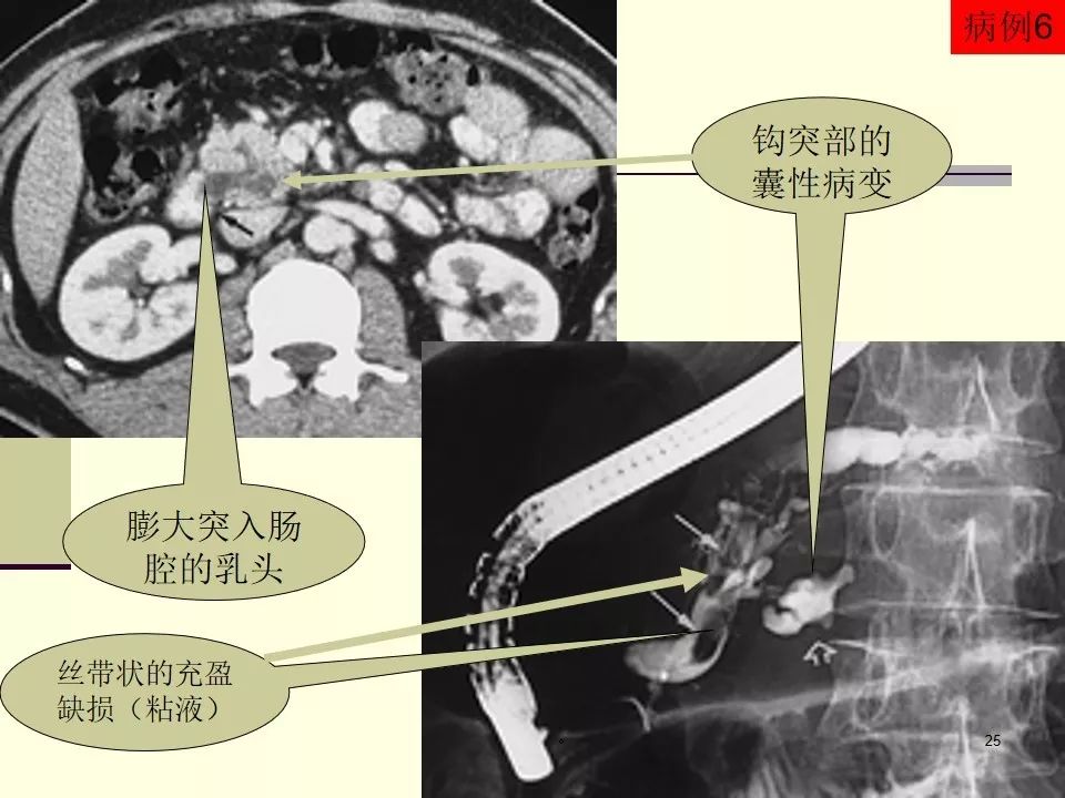 胰腺导管内乳头状黏液瘤