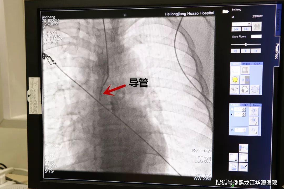 导管下行过程非常困难