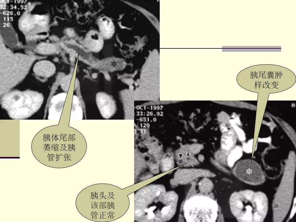 胰腺导管内乳头状黏液瘤