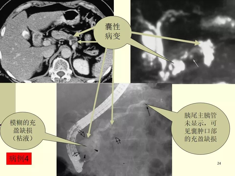 胰腺导管内乳头状黏液瘤