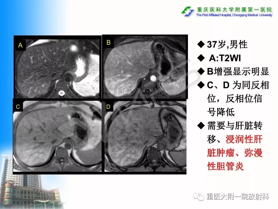 肝脏脂肪变性影像学特征及鉴别诊断