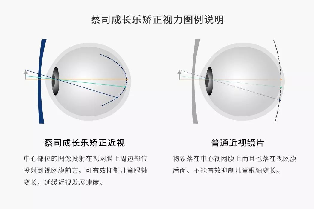 缺点:近视控制效果弱于隐形眼镜,镜片周边有模糊感 1 普通镜片的成像