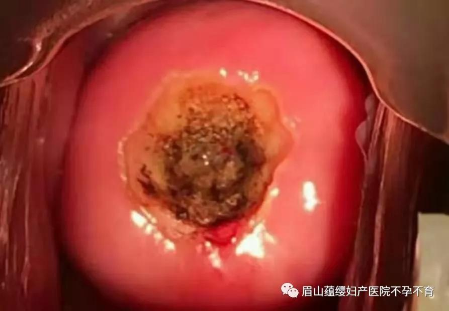 报告返回后,符合cin2级,月经干净后,行宫颈锥切术.