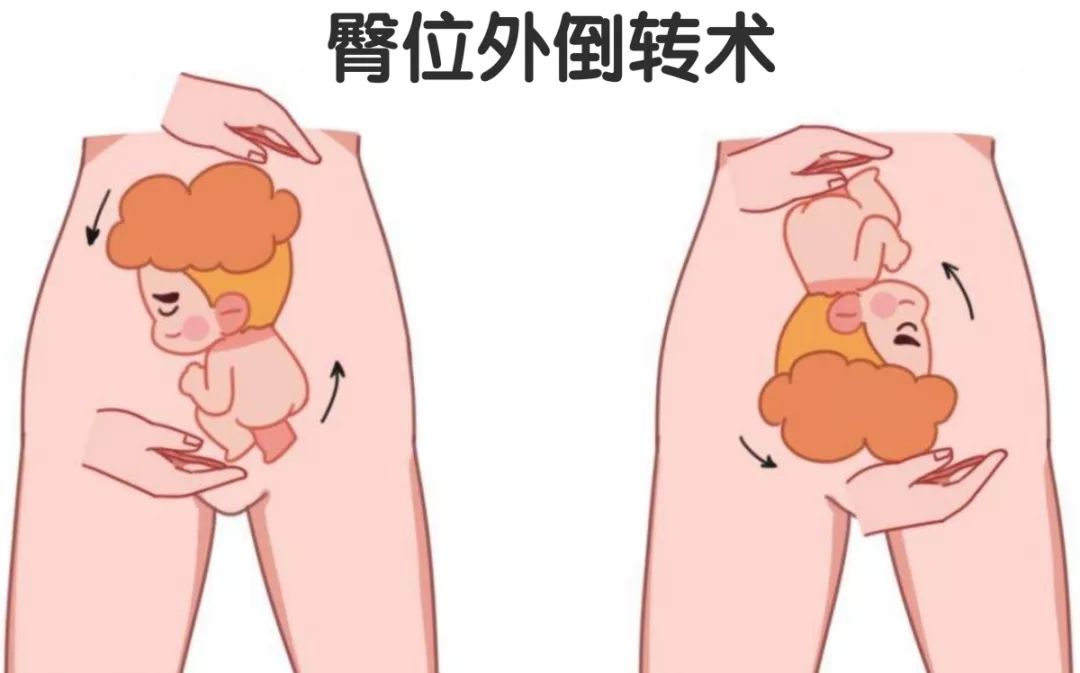 肚子里的 孩子目前是臀位,如果到足月还是臀位的话,就需要剖宫产