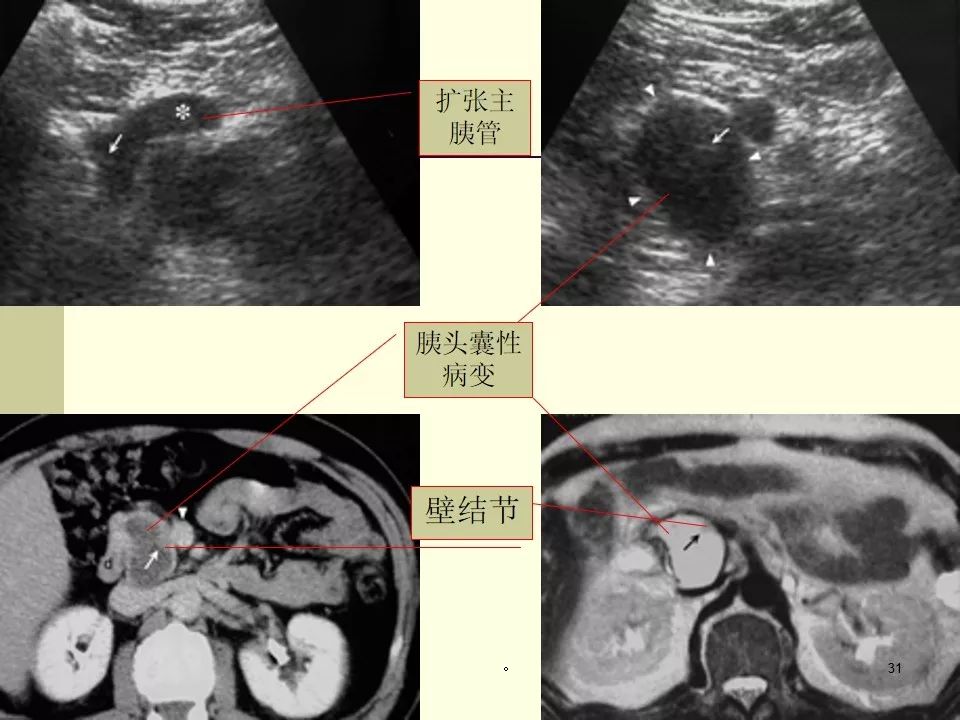 胰腺导管内乳头状黏液瘤