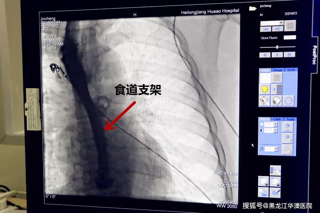 手术过程中,通过多次的尝试后,食道支架终于成功放置,由于患者食管癌