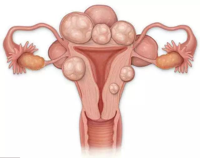 子宫肌瘤年轻化背后的秘密