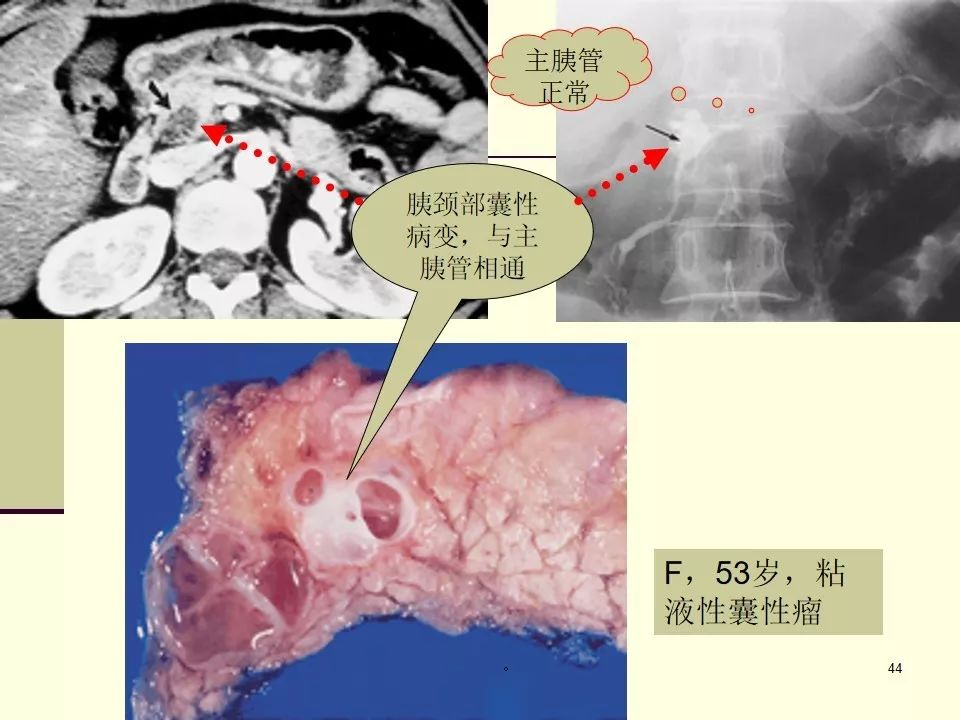 胰腺导管内乳头状黏液瘤