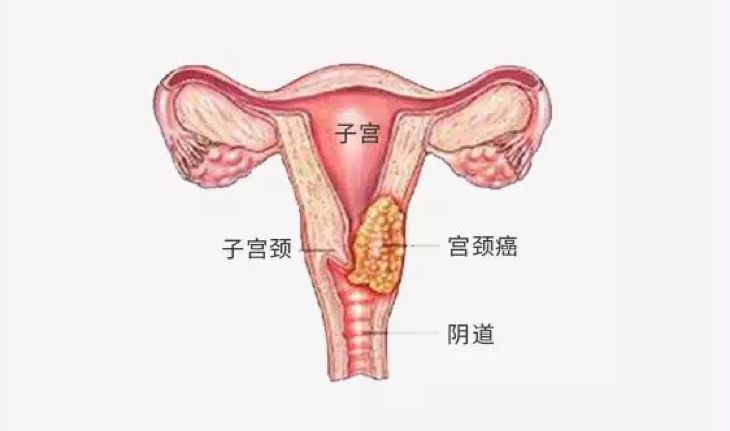 hpv不但是宫颈癌的病因,也是阴道癌,外阴癌,肛门癌,阴茎癌和口咽癌