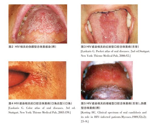 健康频道:艾滋病与口腔还有这种关系?这些情况你一定要警惕