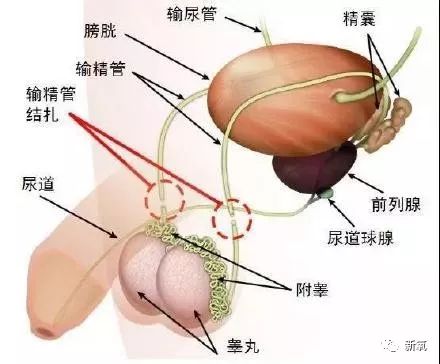 男性结扎的原理_男性结扎原理:切断输精管(3)