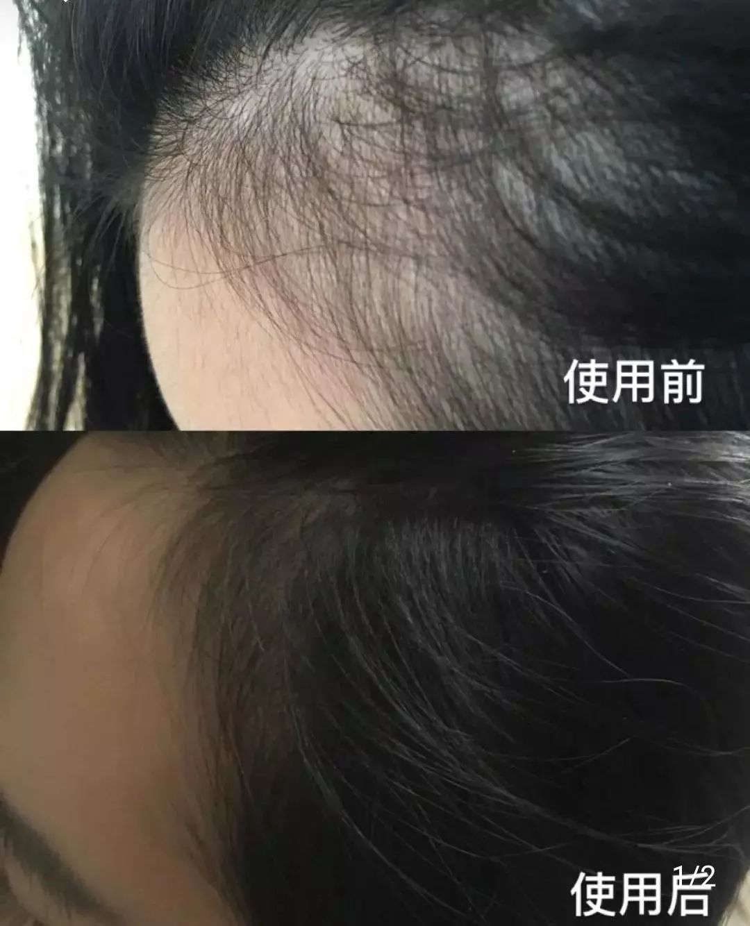 怎么改善发际线脱发 17c3a3c98f724d948624a1bbac1d7898.jpeg