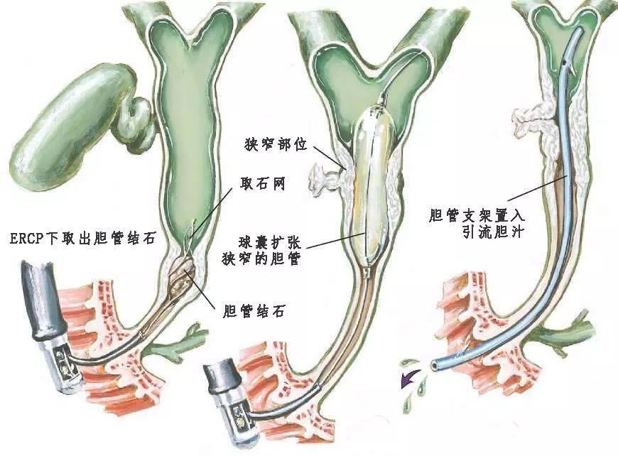 (ercp)