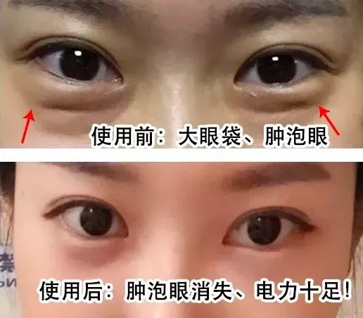 什么东西可以去眼角皱纹 35842ccb98ab423298e5e95efc0ef817.jpeg