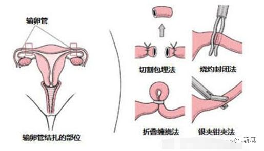 男性结扎的原理_男性结扎原理:切断输精管