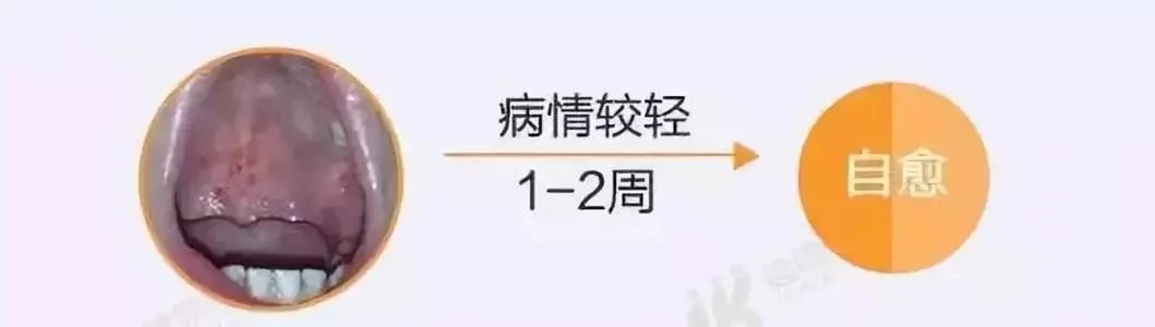 疱疹性咽峡炎可以通过口沫传播,但是一般发生于儿童与儿童之间,成人