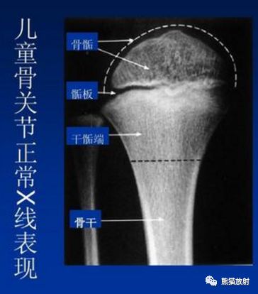 骺板又名生长板,位于骨骺与干骺端之间,是一种薄板波浪状的软骨组织.