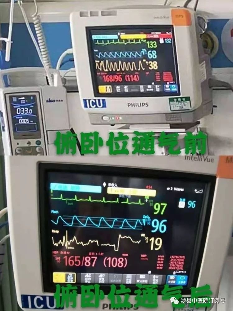 患者实施俯卧位通气治疗前后监护仪参数变化.