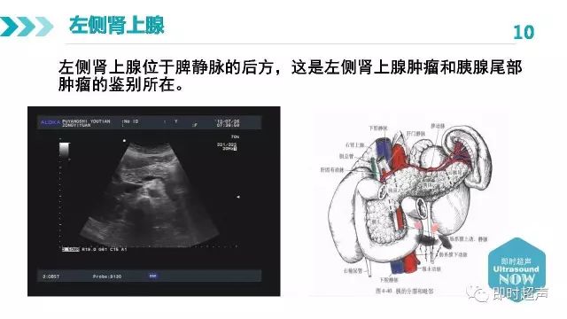 肾上腺正常解剖及疾病超声诊断