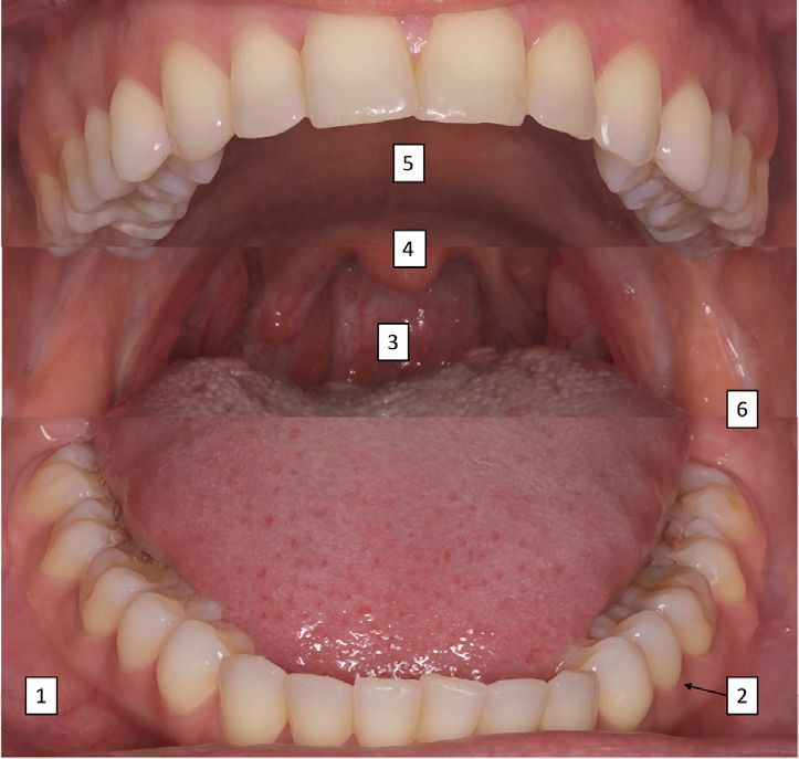 口腔基本解剖.1,前庭;2,牙龈;3,口咽;4,悬雍垂;5,硬腭;6,磨牙后三角.