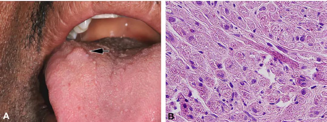 良性口腔黏膜病变:临床及病理表现