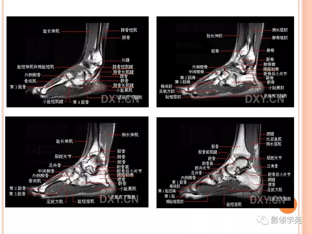 踝关节mri解剖和常见损伤类型