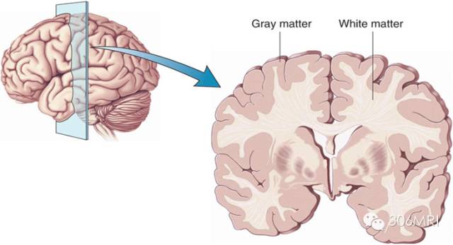 磁共振脑白质区内斑点影解读