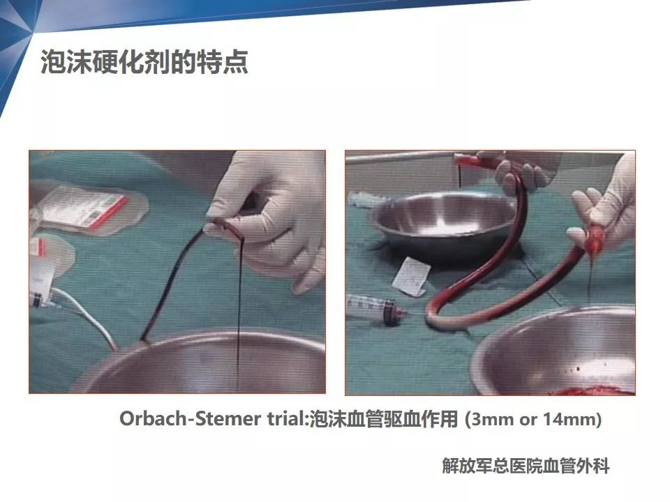 教学ppt 泡沫硬化剂及其在静脉疾病中的临床应用