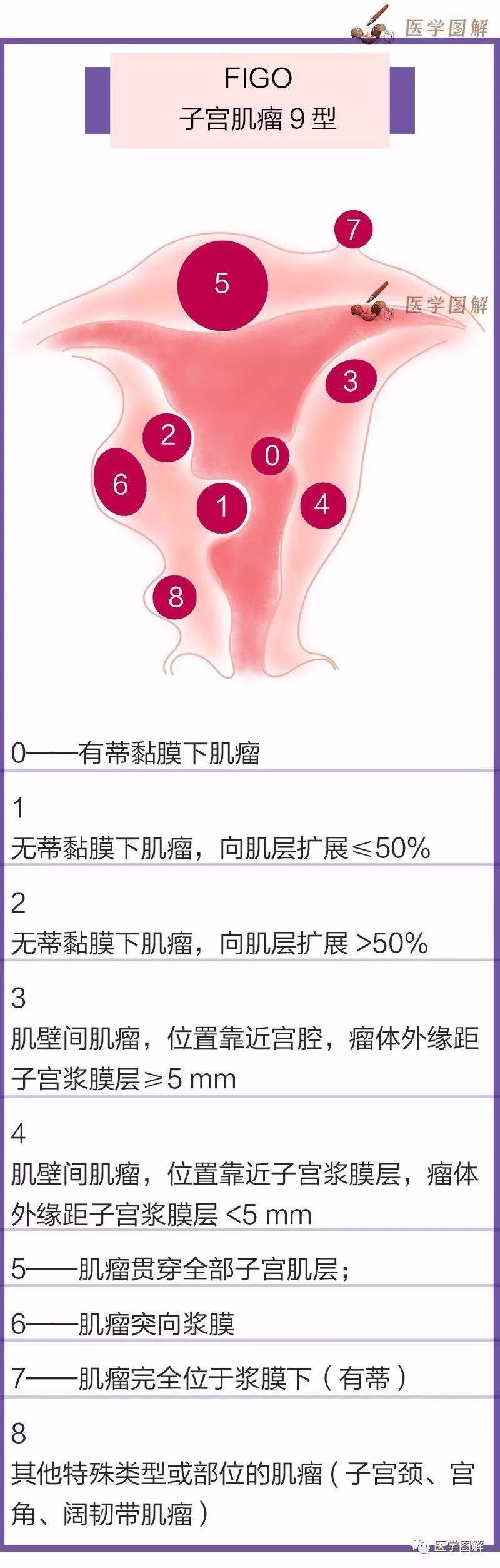 附:子宫肌瘤分型