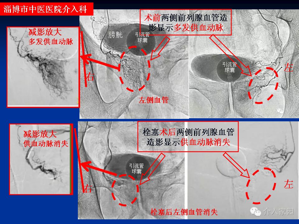 前列腺动脉栓塞术—守住男人的生命"腺"