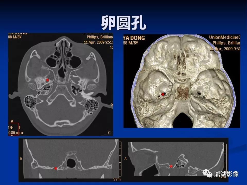 必点收藏 | 超详细颅底影像解剖,千万不要错过