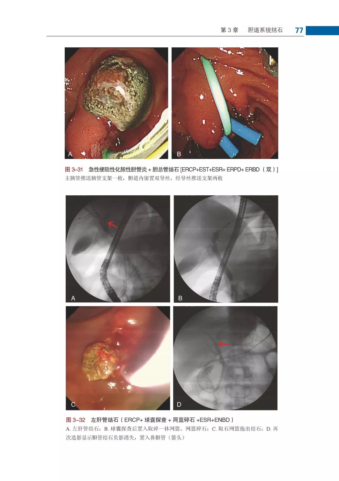 内镜技术皇冠上的明珠胆道疾病ercp影像学典型图谱