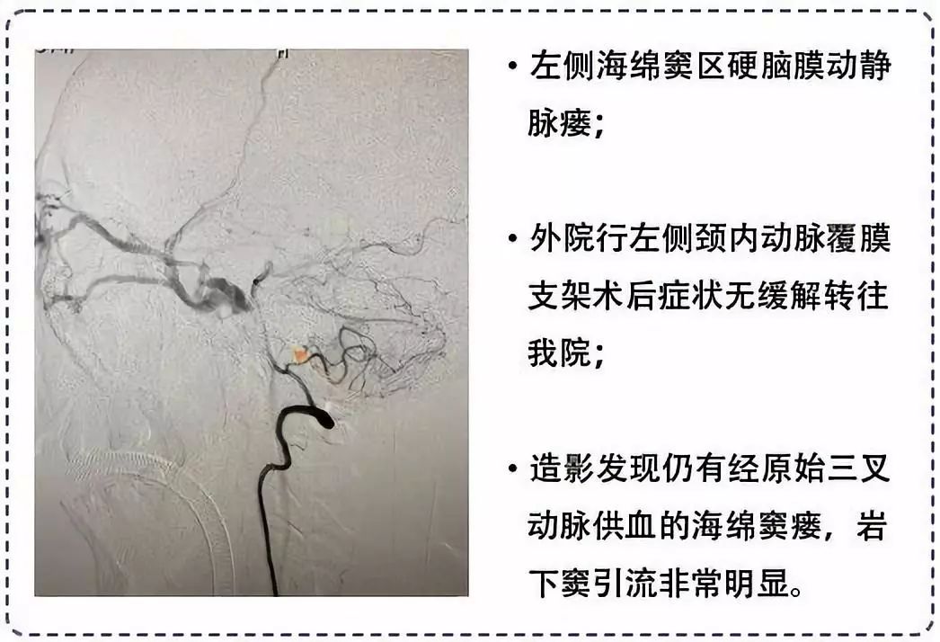 经典岩下窦入路:下面结合具体病例进行详细说明·颈外静脉-翼丛-海绵