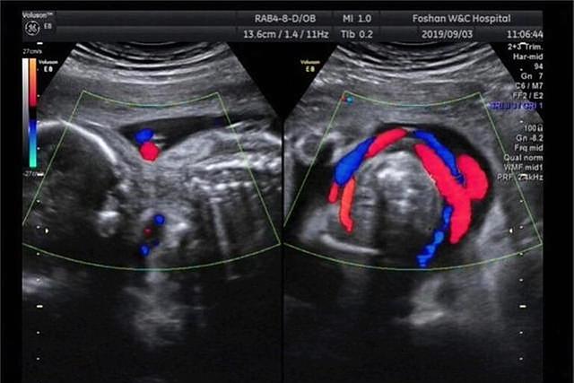 孕期第24周产检,发现胎儿脐带"打结",孕妈起祈祷:愿宝宝平安