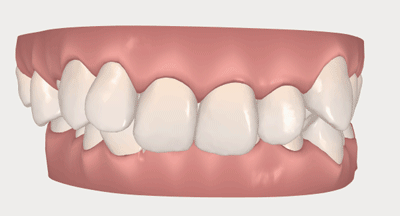 合生齿科dr.吕原锋-牙齿深覆颌矫正病例讲解