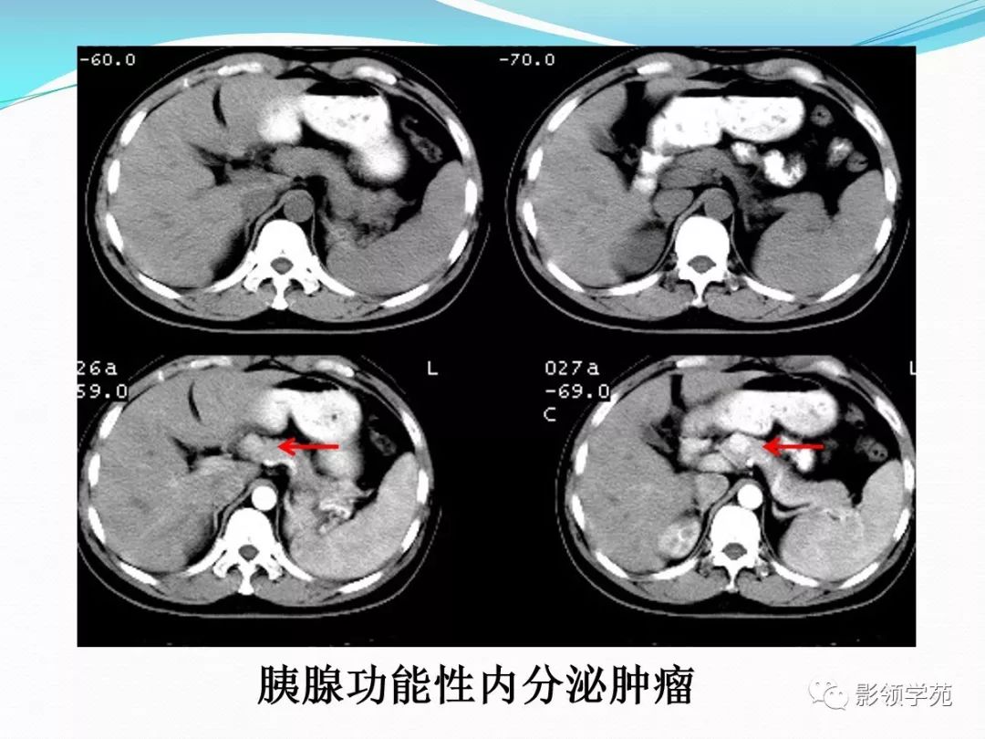 胰腺常见原发肿瘤的ct表现