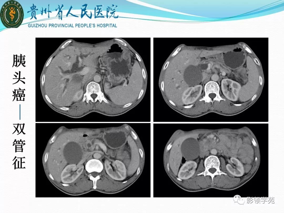 胰腺常见原发肿瘤的ct表现