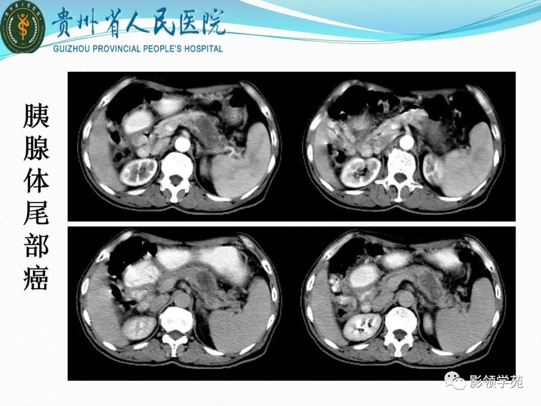 胰腺常见原发肿瘤的ct表现