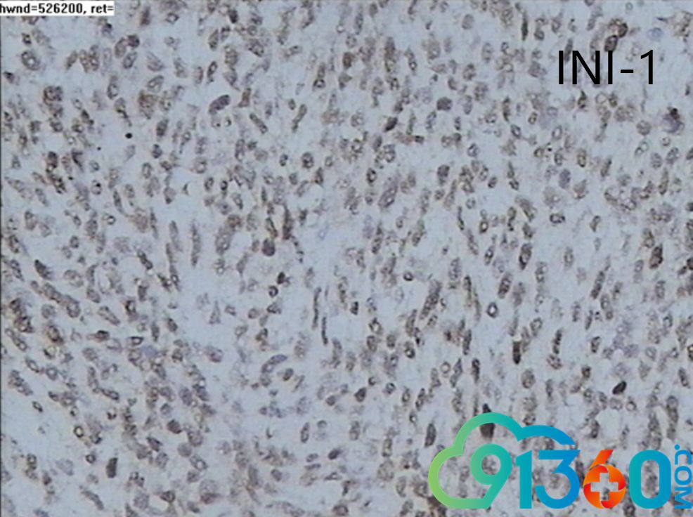 免疫组化结果: 阳性:vimentin,ini-1,s100,cd56,pgp9.