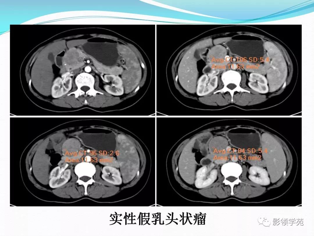 胰腺常见原发肿瘤的ct表现