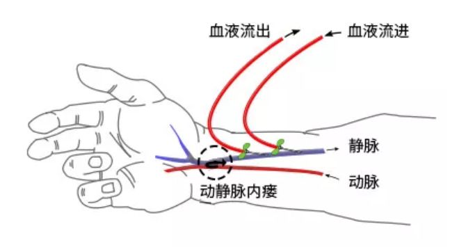 静脉内瘘功能不良的难题,且扩张成功后,可立即作为血管通路进行血液